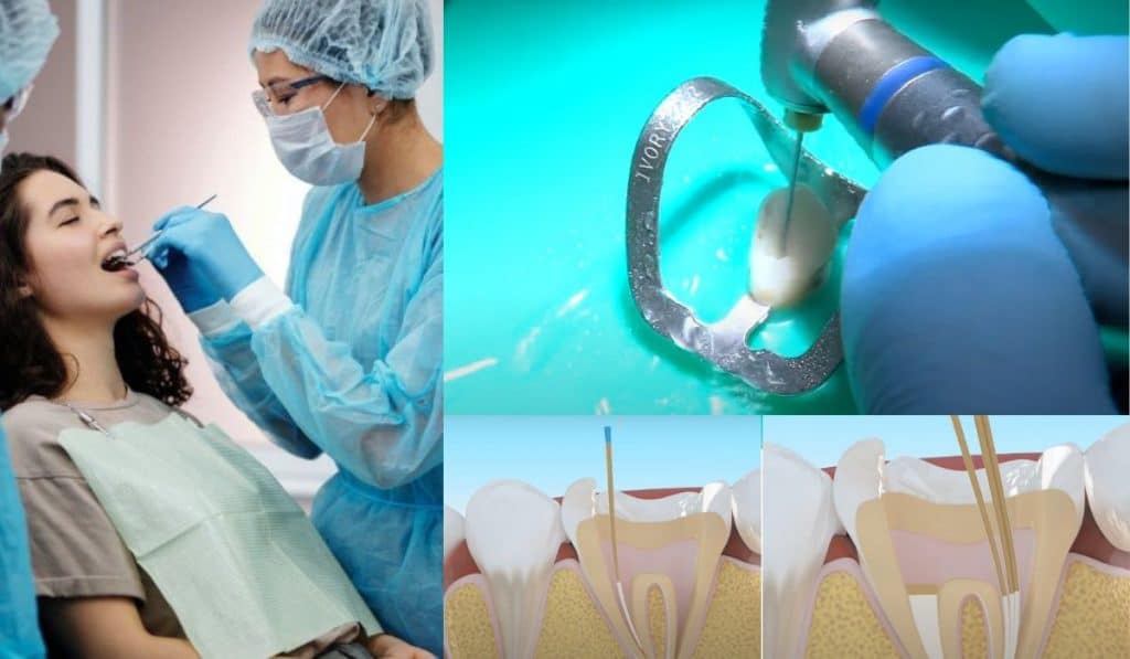 Que es la endodoncia