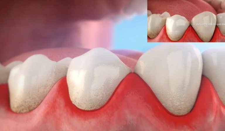 Que es la gingivitis y cuáles son sus síntomas